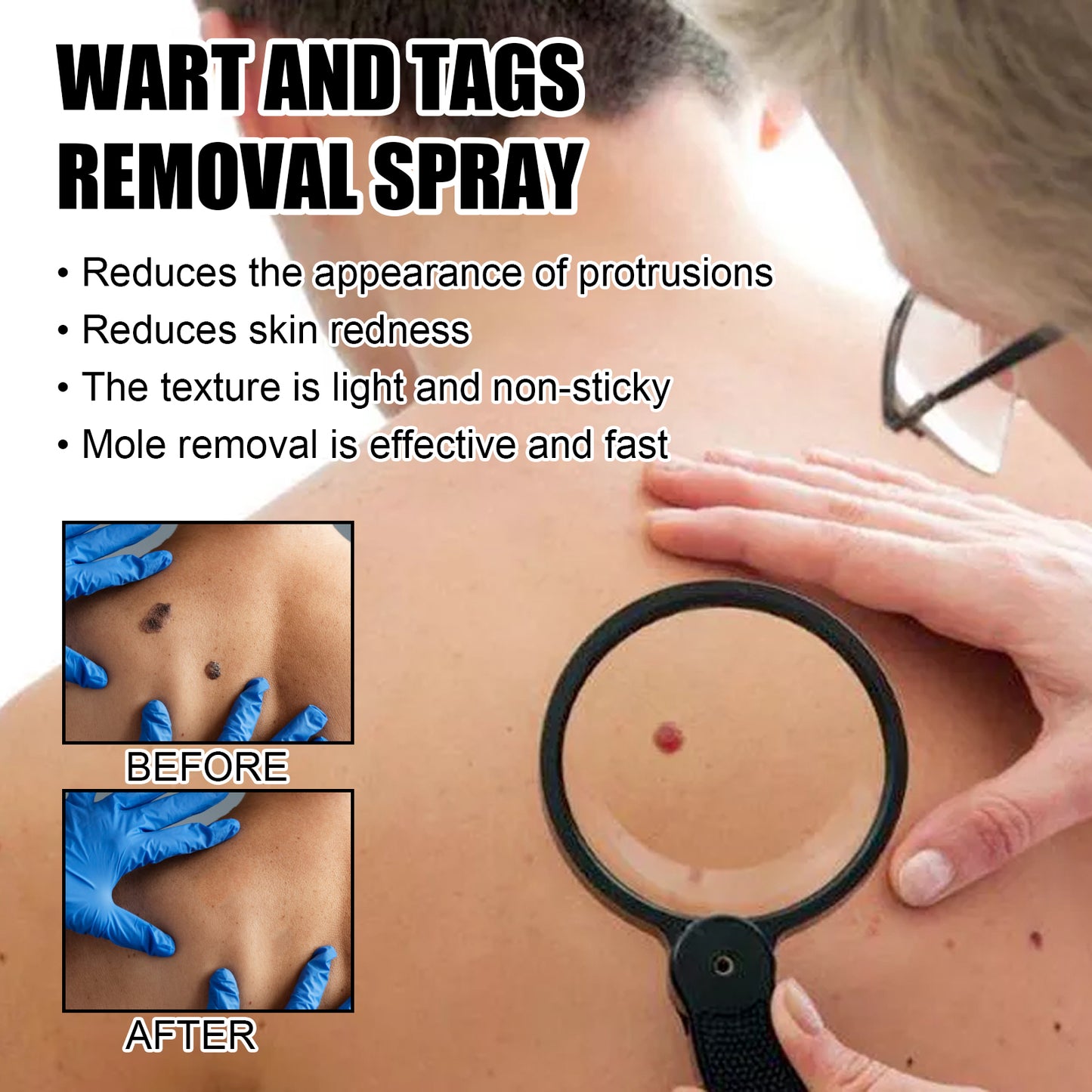 Ximonth Wart And Tags Removal Spray, Cleanse And Fade Body Moles Smooth Skin Repair Spray
